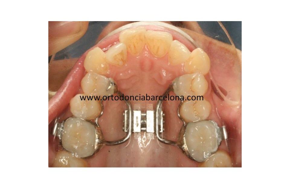 Foto 1 del artículo del Doctor Fernando de la Iglesia sobre SARPE (Surgical Assisted Rapid Maxillary Expansion)