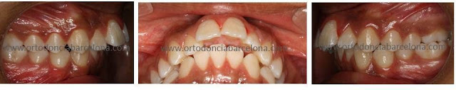 Foto 1 del artículo del Doctor Fernando de la Iglesia sobre Ortodoncia y Estética Dental mediante extracciones dentales