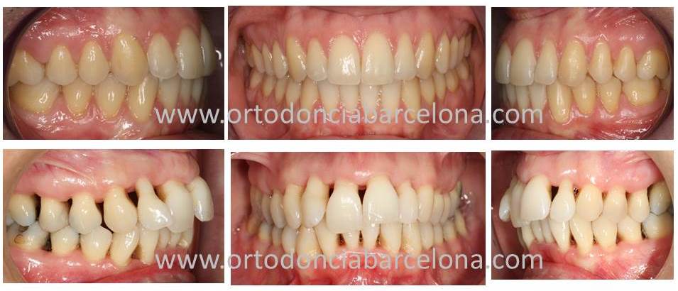 Foto 1 del artículo del Doctor Fernando de la Iglesia sobre Ortodoncia en pacientes con problemas de encía o Enfermedad Periodontal