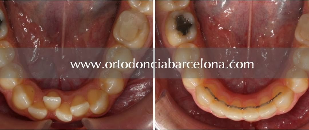 Foto 1 del artículo del Doctor Fernando de la Iglesia sobre Retención dental en ortodoncia
