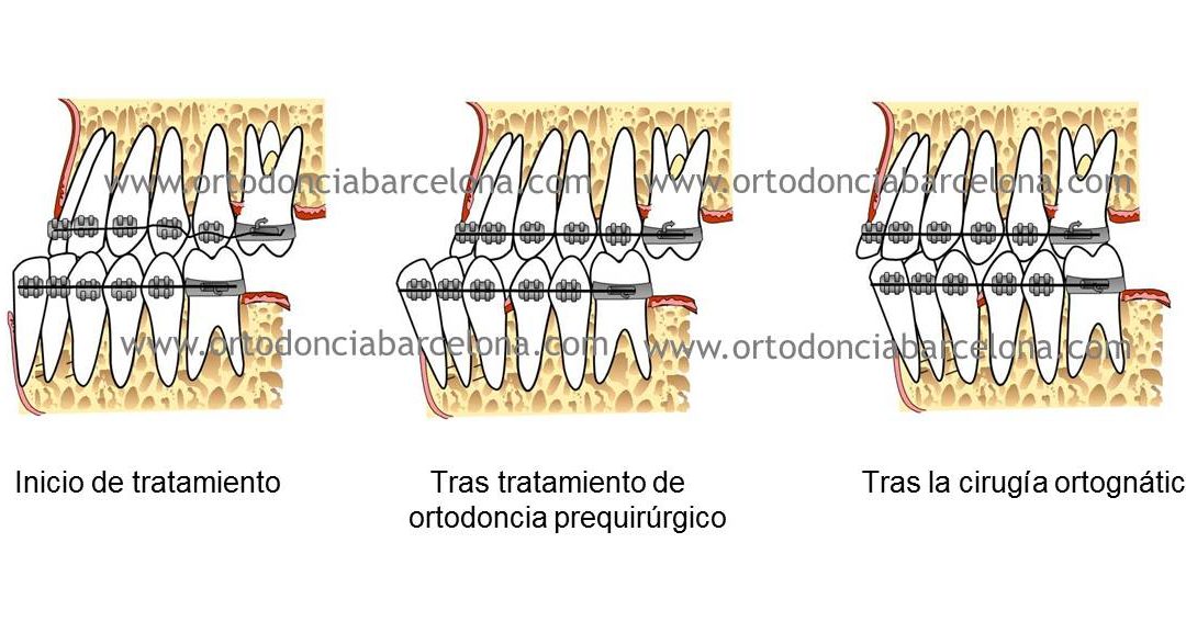 Foto 1 del artículo del Doctor Fernando de la Iglesia sobre Ortodoncia y Surgery First en Barcelona