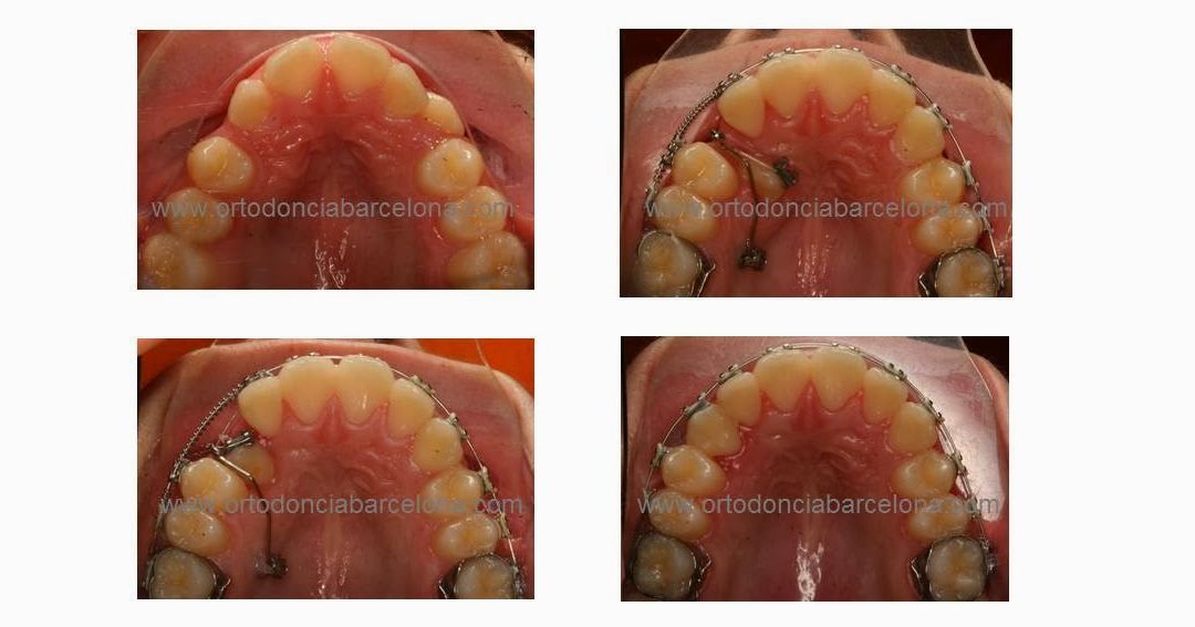 Foto 1 del artículo del Doctor Fernando de la Iglesia sobre Tracción de Caninos incluidos o impactados con microtornillos ortodóncicos