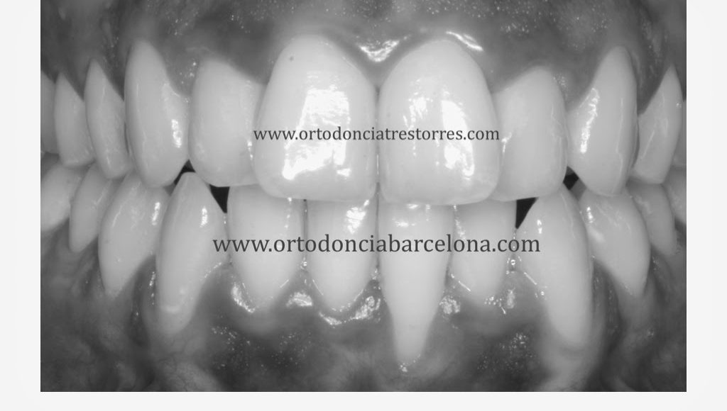 Foto 1 del artículo del Doctor Oriol Quevedo sobre Recesión Gingival. ¿Por qué aparece? ¿Cómo se trata?
