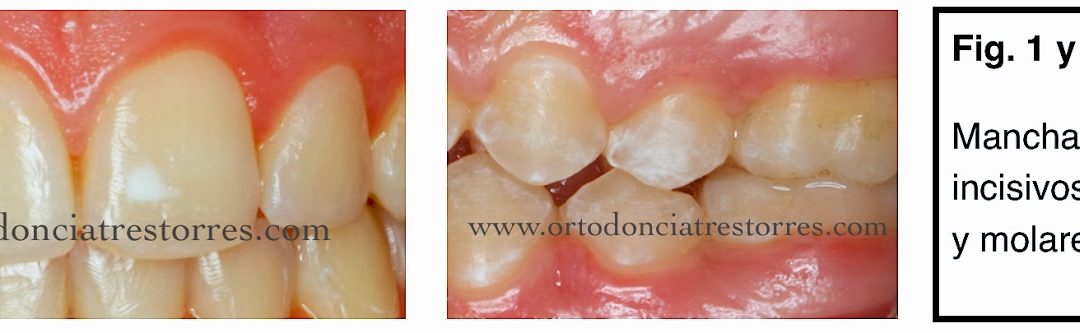 Foto 1 del artículo del Doctor Fernando de la Iglesia sobre Manchas blancas dentales. Causas y prevención. ¿La ortodoncia produce manchas blancas?