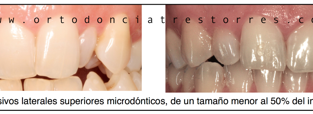 Foto 1 del artículo del Doctor Oriol Quevedo sobre Tratamiento de los incisivos laterales pequeños (Microdónticos y/o Conoides)