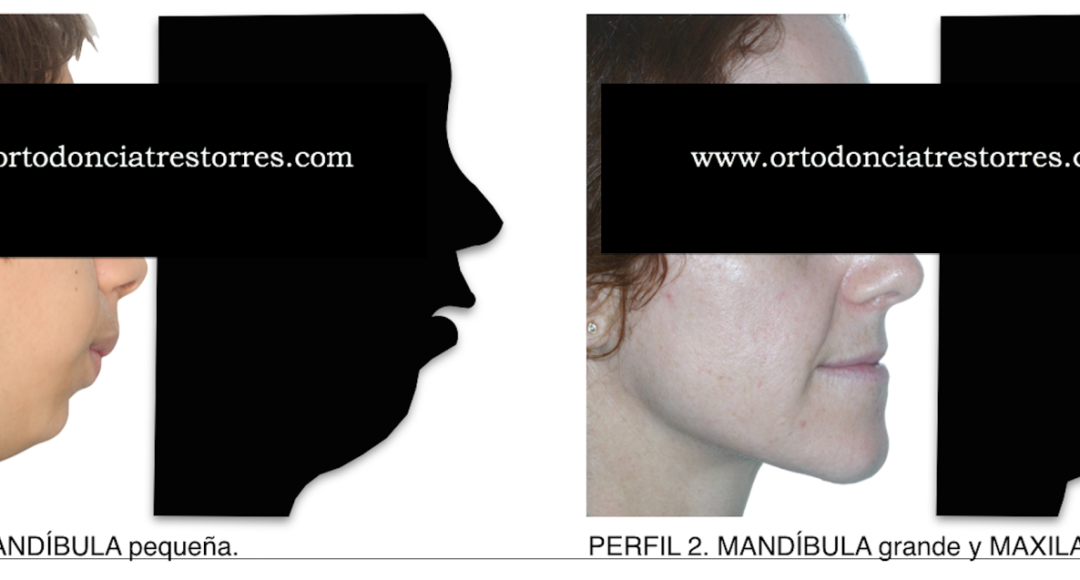 Foto 1 del artículo del Doctor Oriol Quevedo sobre ORTODONCIA QUIRÚRGICA & CIRUGÍA ORTOGNÁTICA. PARTE 1: AVANCE MANDIBULAR. (RETROGNATIA MANDIBULAR, HIPOPLASIA MANDIBULAR, CLASE II MANDIBULAR)