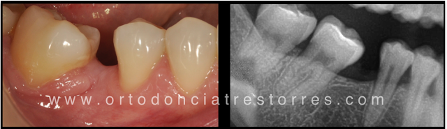Foto 1 del artículo del Doctor Fernando de la Iglesia sobre INVISALIGN & CORTICOTOMÍAS. Caso de RECUPERACIÓN de ESPACIO