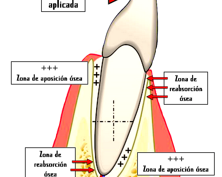 Foto 1 del artículo del Doctor Fernando de la Iglesia sobre ¿Duelen los dientes al empezar el tratamiento de ortodoncia? ¿Por qué? ¿Cómo se mueven los dientes?