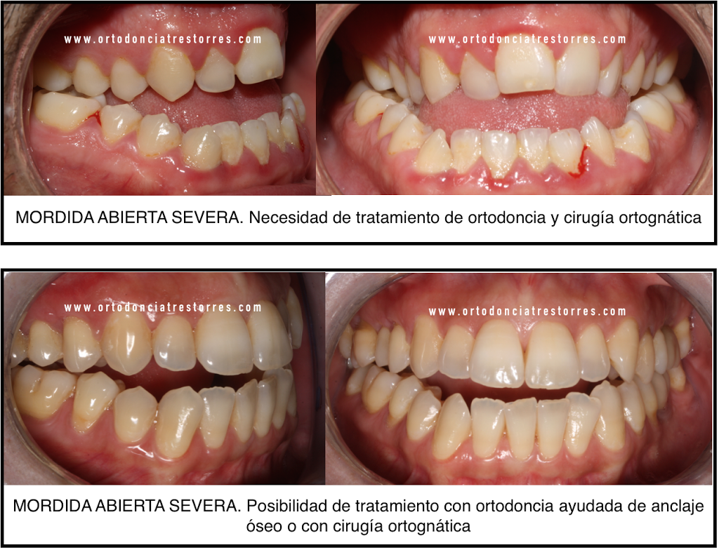 Foto 3 del artículo del Doctor Fernando de la Iglesia sobre ¿Qué es una mordida abierta? ¿Cómo y por qué se produce? ¿Cómo se trata?