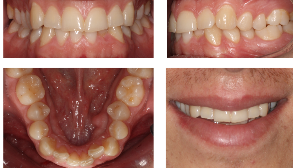 Foto 1 del artículo del Doctor Fernando de la Iglesia sobre Tratamiento de Ortodoncia Invisible mediante el sistema Invisalign en Barcelona