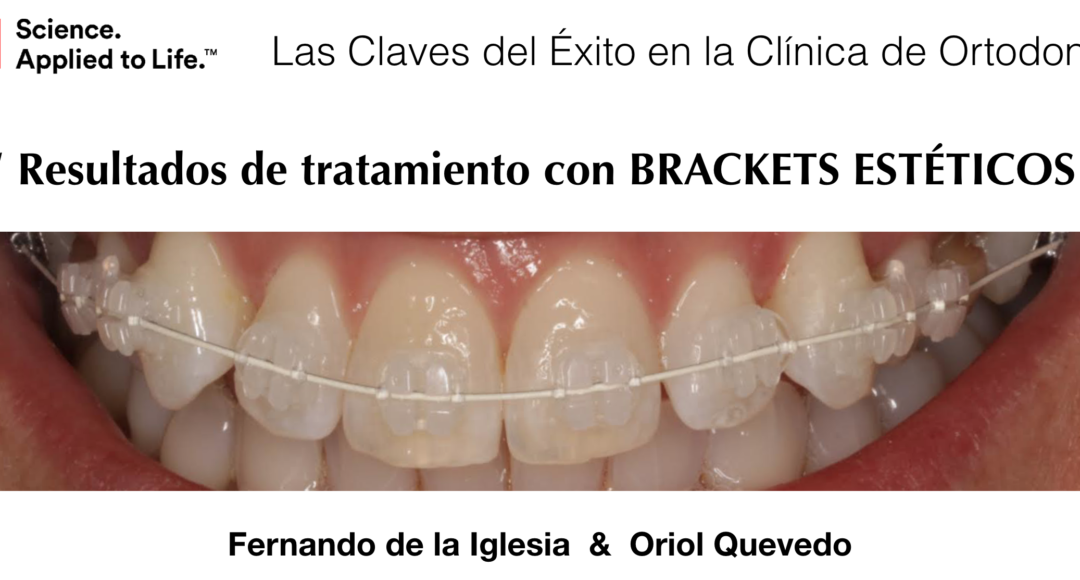 El Doctor Fernando de la Iglesia publica un artículo sobre “Las Claves del Éxito en la Clínica de Ortodoncia. Tratamiento con brackets estéticos"