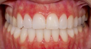 Sonrisa después del tratamiento Invisalign que se terminó con cuatro carillas de incisivo lateral a incisivo lateral