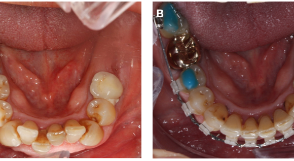 Gracias al tratamiento de ortodoncia, los dientes se alinean y facilita el cepillado dental
