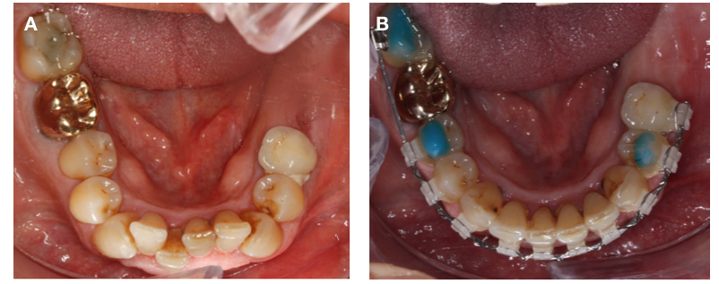 Gracias al tratamiento de ortodoncia, los dientes se alinean y facilita el cepillado dental