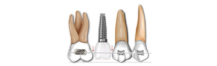 Ortodoncia con implantes