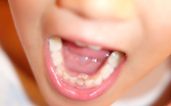 El recambio dentario en los niños empieza sobre la edad de los 6 años y dura hasta los 8 años