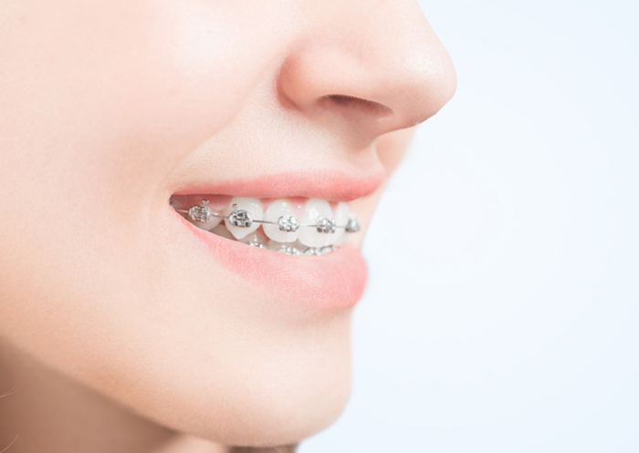Durante un tratamiento de ortodoncia los cuidados e higiene son importantes, la óptima limpieza dental durante la ortodoncia mejora la experiencia