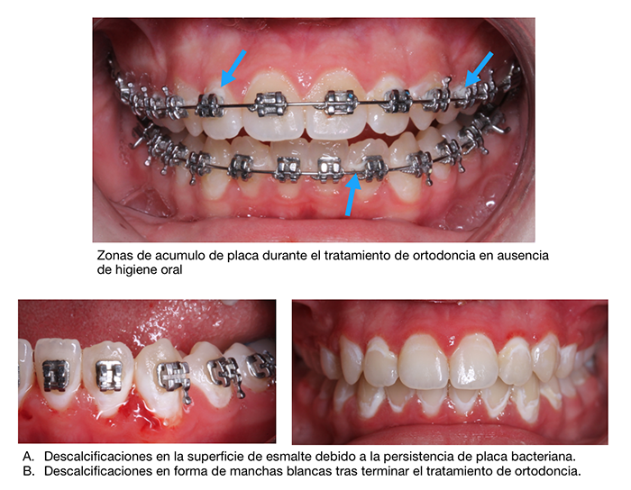 Caries Durante La Ortodoncia Y Manchas Blancas Caries Durante La Ortodoncia Y Manchas Blancas