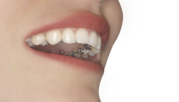 Imagen de un aparato lingual a base de brackets cementados en la cara interna de los dientes utilizado en la técnica lingual de ortodoncia invisible