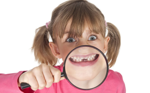 Imagen de una dentadura con mordida cruzada en la que se observa que los dientes de la arcada superior no abrazan correctamente a los de la arcada inferior