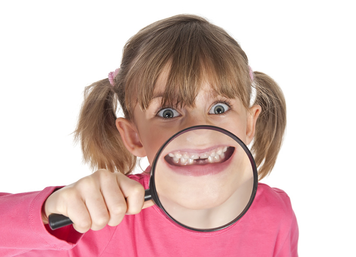 Imagen de una dentadura con mordida cruzada en la que se observa que los dientes de la arcada superior no abrazan correctamente a los de la arcada inferior