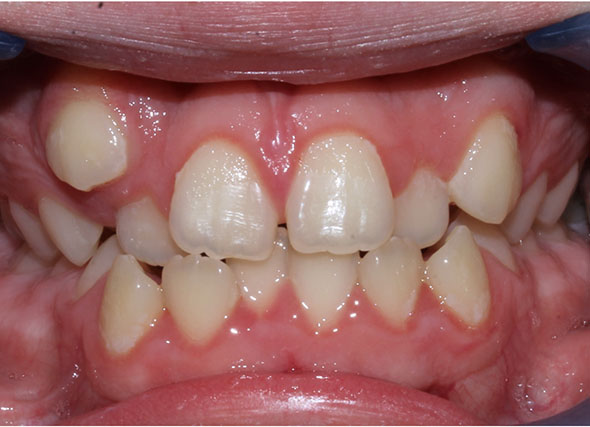Primer plano de una dentadura que presenta colmillos montados o caninos elevados