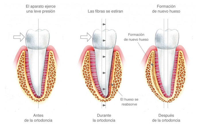 Imagen de las modificaciones que sufre el ligamento periodontal durante la ortodoncia que permite que el diente se desplace a la posición deseada