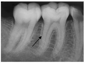 La flecha de la imagen señala el ligamento periodontal del diente
