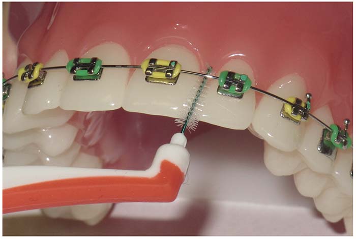 Primer plano de un cepillo interdental entre el alambre de la ortodoncia fija y el diente