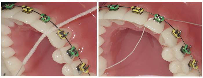 Hilo dental Superfloss pasando por debajo del alambre de ortodoncia fija, a la izquierda parte rígida y a la derecha la parte convencional