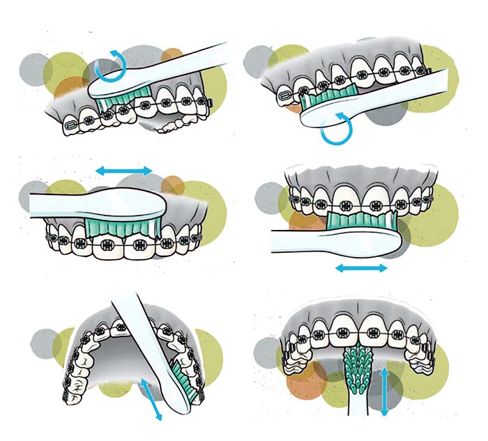 Secuencia del cepillado de dientes con ortodoncia fija que muestra cómo cepillar todas las caras del diente