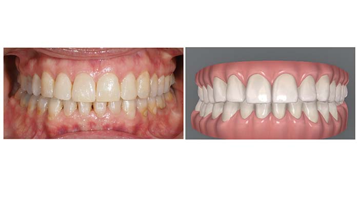 Ejemplo del resultado del tratamiento de intrusión progresiva con Invisalign con el que se obtiene una correcta oclusión anterior
