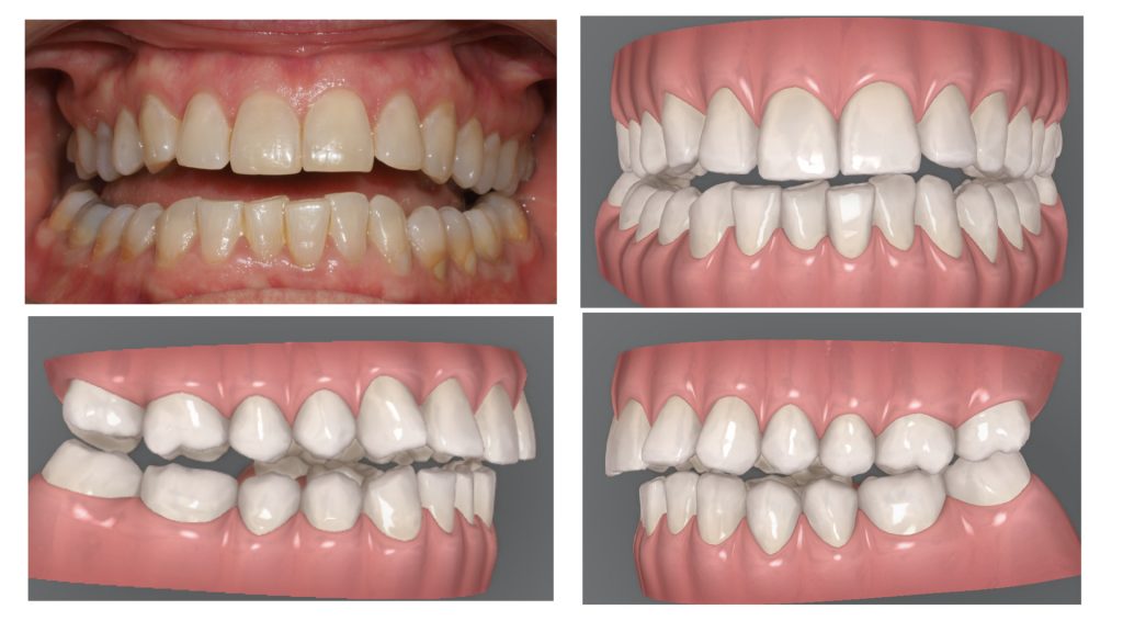 4 ejemplos de mordida abierta anterior donde el único contacto dental se situa en los segundos molares