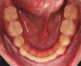 Primer plano de la dentadura tratada con Invisalign en la que se ha colocado una retención fija inferior