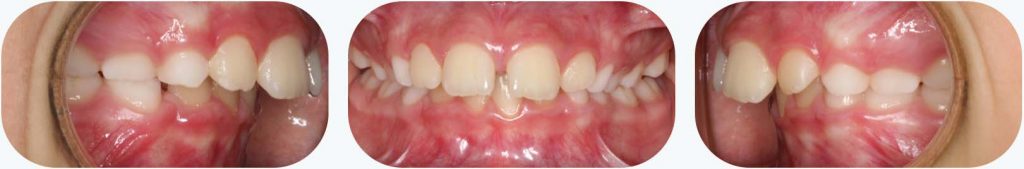 Vista frontal y lateral de la mandíbula de un paciente con protrusión dental
