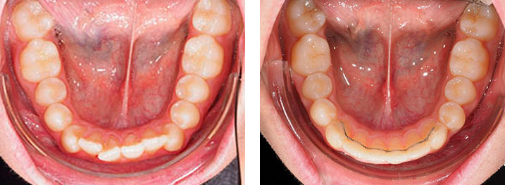 Primer plano de la secuencia antes y después del tratamiento de ortodoncia para alienar los dientes inferiores torcidos