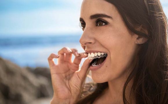 Imagen de una chica con ortodoncia Invisalign para introducir post Alternativas Invisalign