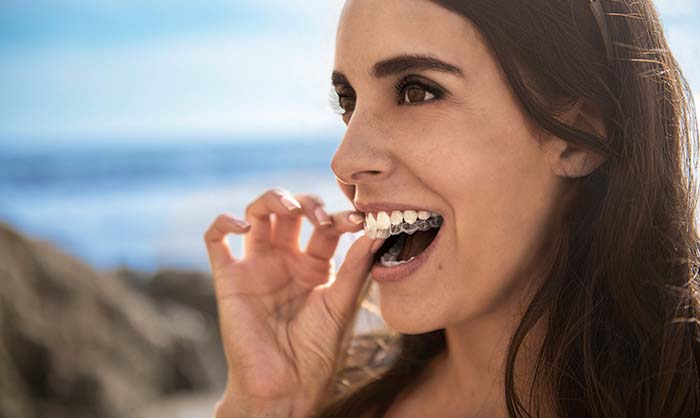 Imagen de una chica con ortodoncia Invisalign para introducir post Alternativas Invisalign
