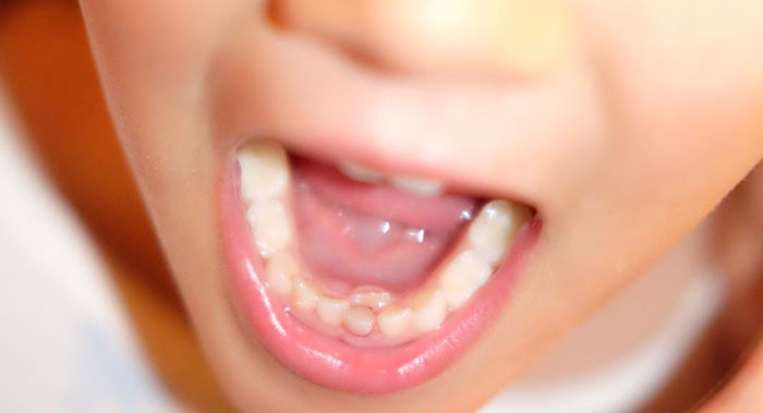 Imagen boca infantil mostrando dientes de leche