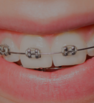 Ortodoncia En Ninos Preventiva Brackets Y Expansores