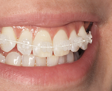Orthodontics Tres Torres visible orthodontics with brackets