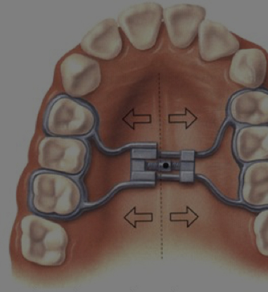 Ortodoncia En Ninos Preventiva Brackets Y Expansores