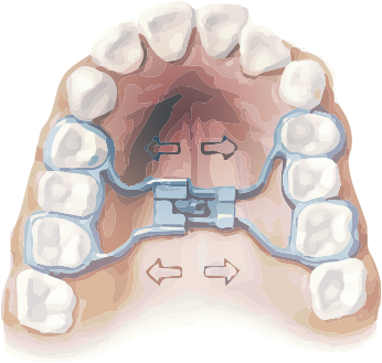 Expansor De Paladar Para Ninos Ortodoncia En Barcelona