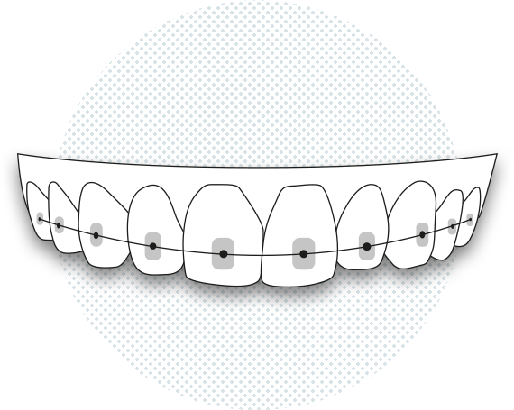 Il·lustració de brackets convencionals