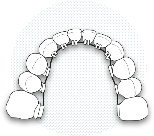 Il·lustració de brackets linguals