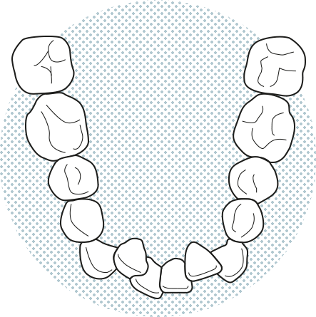 Illustració de dents apinyades