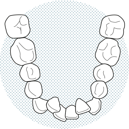Illustracio-dents-apinyades Illustració de dents apinyades