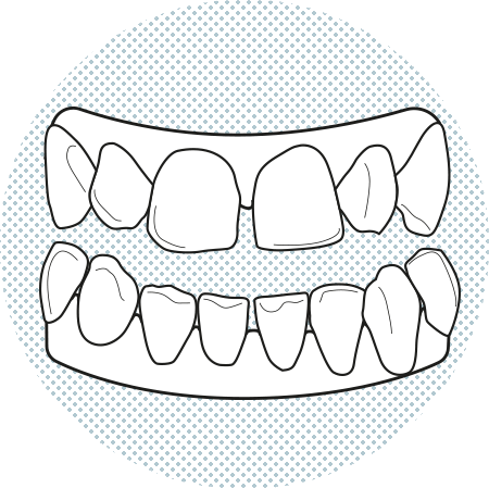 Illustration of denture with teeth separated