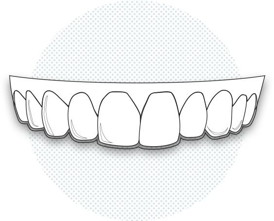 Il·lustració d'un aligner