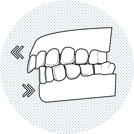 illustracio-dentadura-maloclusio Il·lustració de dents frontals superiors que sobresurten per damunt dels inferiors